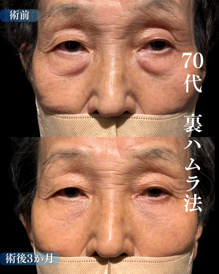 70代男性　裏ハムラ法